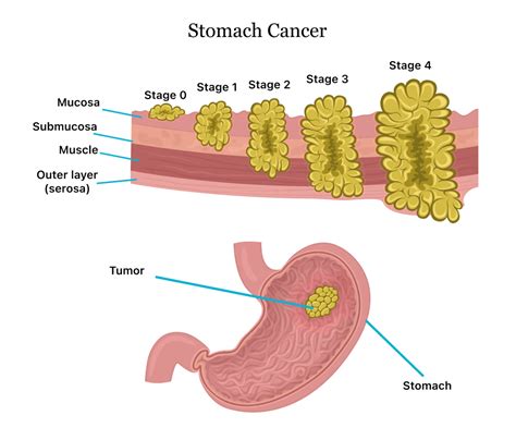 Stomach Cancer Stages Chart