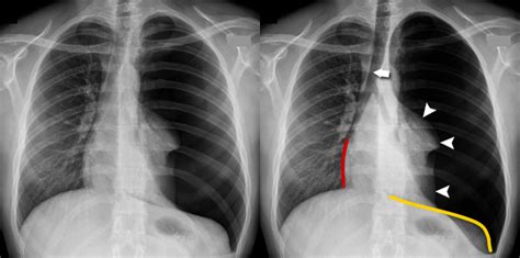 Tension Pneumothorax X Ray Findings