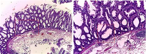 GASTROINTESTINAL AND LIVER HISTOLOGY PATHOLOGY ATLAS: SESSILE SERRATED POLYP (AKA SESSILE ...