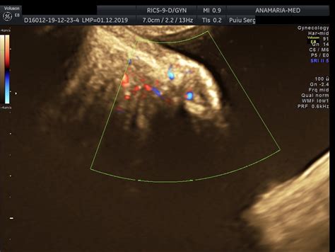 Ultrasound diagnosis of bladder endometriosis [Dec 2022] – EFSUMB