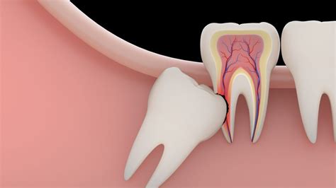 How To Help Wisdom Tooth Pain - Askexcitement5