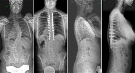 Commonly Performed Scoliosis Surgeries Before & After—2CN - Michael G. Vitale MD MPH