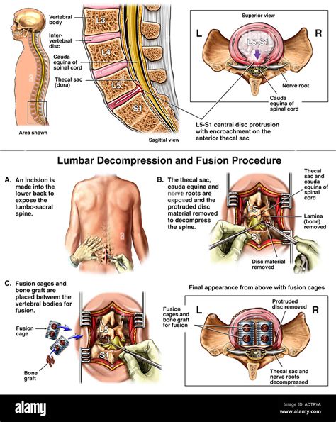 Lumbar Spine Injury - L5-S1 Disc Herniation with Posterior Spinal Stock Photo, Royalty Free ...