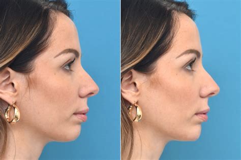 Injectable Fillers photos | Philadelphia, PA | Patient 1368