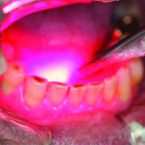 Sublingual caruncle fifteen days after biopsy and suture present ...