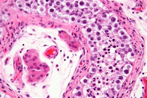 What is a Neoplasia: Examples, Types and Causes - Scope Heal