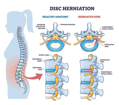 Herniated Disk Treatment | Osteoklinika