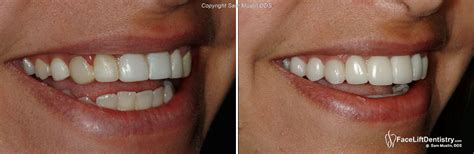 Replacing Bad Porcelain Veneers