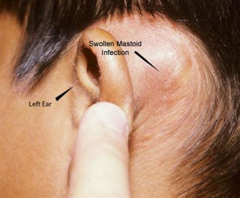 Swollen Lymph Nodes Behind Ear Cancer, Causes, Symptoms, Pictures, Painful, Doesn’t Hurt ...