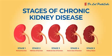 Kidney Disease: Types, Symptoms & Diagnosis - Dr Lal PathLabs Blog