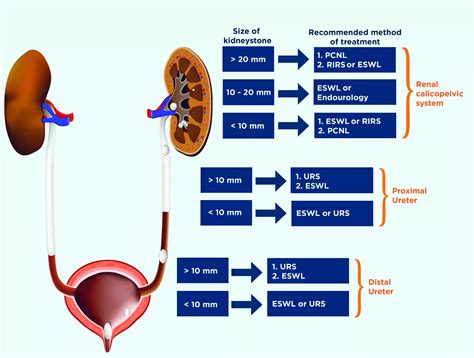 Which Kidney Stone Treatment Method is Right for Me? — Dornier MedTech