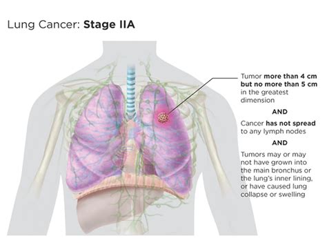 Lung Cancer Staging | LUNGevity Foundation