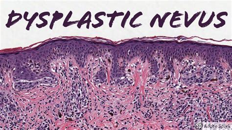 Benign Nevus Histology