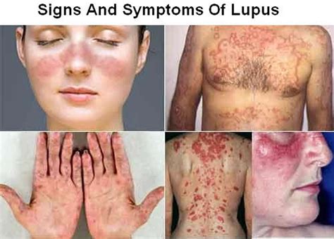 Lupus - Systemic Lupus Erythematosus (SLE) - Causes, Sign & Symptoms