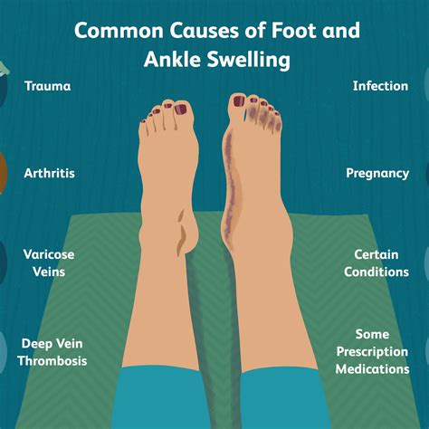 How To Keep Ankles From Swelling - Aimsnow7