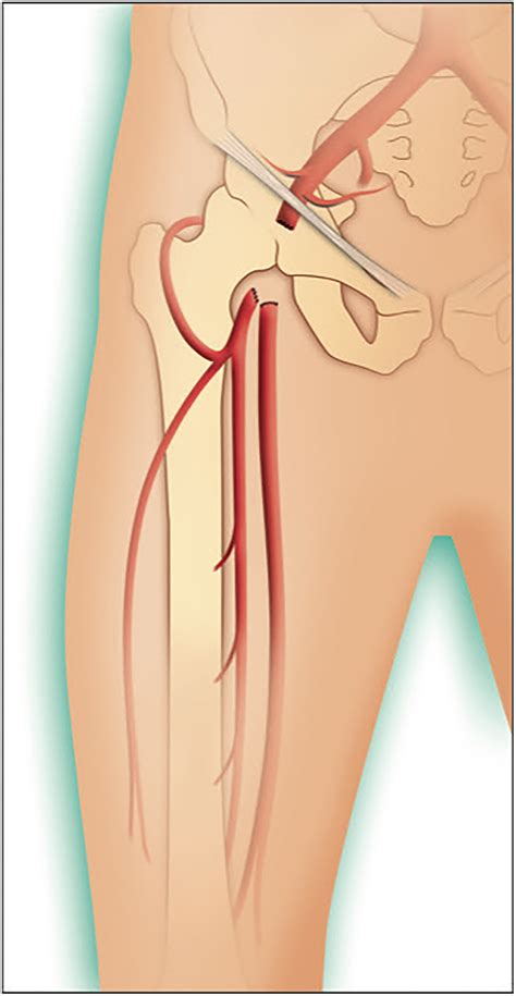 Femoral artery ligature for treatment of infected groin pseudoaneurysm ...