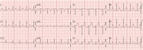 Dr. Smith's ECG Blog: Slightly Peaked T-waves, What is it?