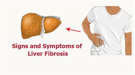 Fibrosis of the Liver: 11 Signs and Symptoms of Liver Fibrosis