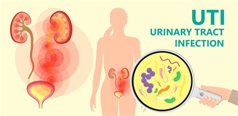 Urinary Tract Infections: Symptoms And Complications, 60% OFF