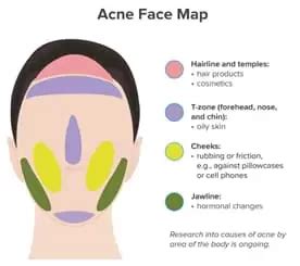 Matchless Info About How To Cure Chin Acne - Policebaby25