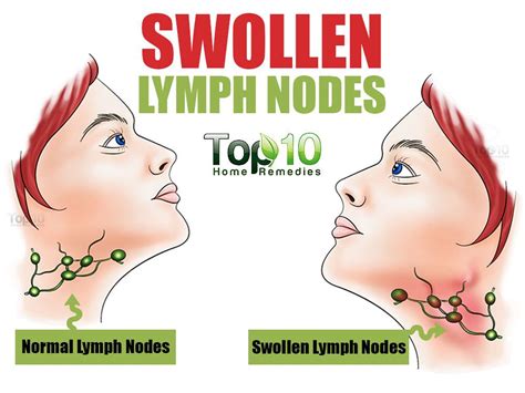 Swollen Lymph Nodes Chin