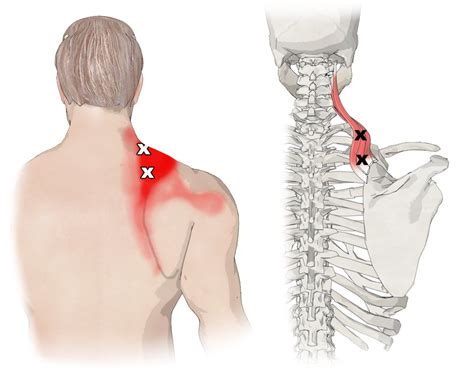 The Levator Scapulae Muscle Its Attachments and Actions - Yoganatomy