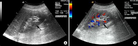 Diagnosing Acute Pyelonephritis with CT, 99mTc-DMSA SPECT, and Doppler Ultrasound: A Comparative ...