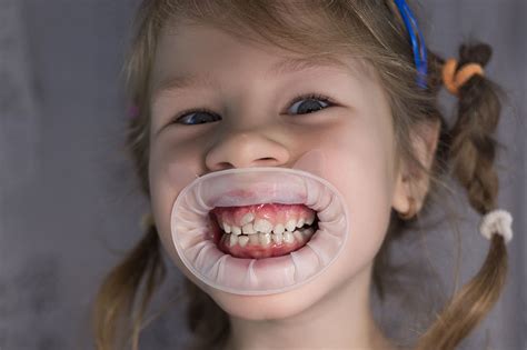 What Shark Teeth Means for a Child's Oral Health | Kenmore, WA | Kenmore Pediatric Dentistry