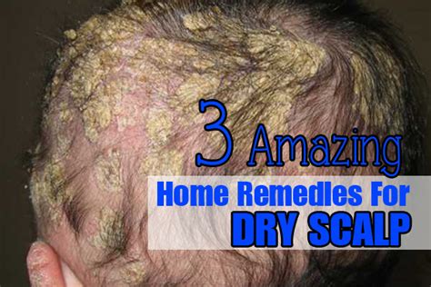 3 Amazing Home Remedies For Dry Scalp | HealthRelieve.com