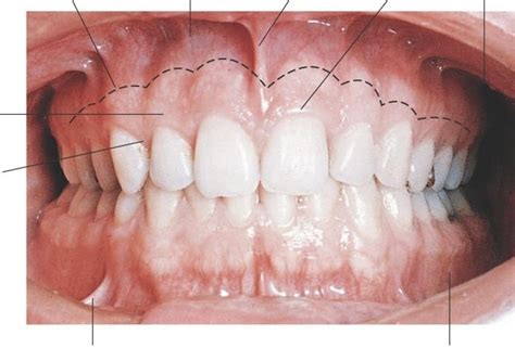 Mucogingival Junction Diagram | Quizlet