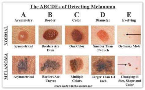 The ABCDEs of Melanoma : Mayha Patel, DO, FAAD: Dermatologist