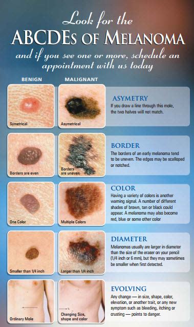 ABCDE's of Melanoma