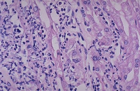 Pathology Outlines - Acute pyelonephritis