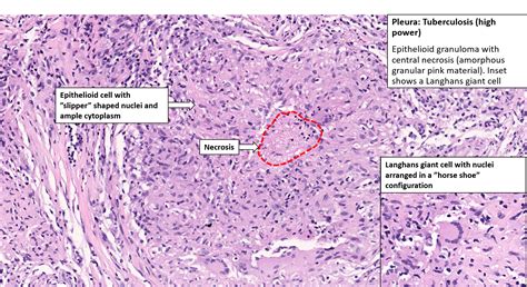 Tuberculosis Microscopy