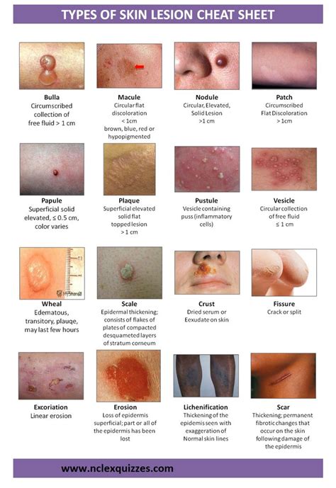 An extensive language has been developed to standardize the description of skin lesions ...