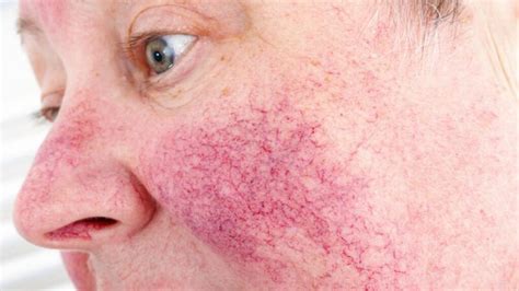 Rosacea: Symptoms, Causes, and Treatments