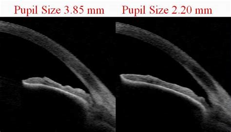 Glaucoma Modesto / Stockton - Anatomically Narrow Angles - Dr. Ash