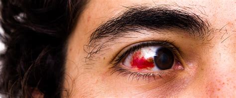 Eye Injuries in Tallahassee - Eye Related Injuries & Eyewear Protection