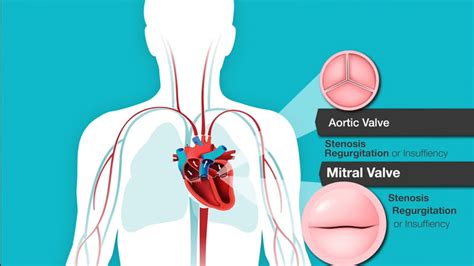 Heart Murmurs and Valve Disease | American Heart Association