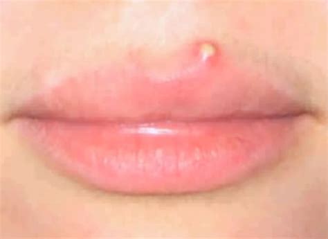 Pimple on lip line | HubPages