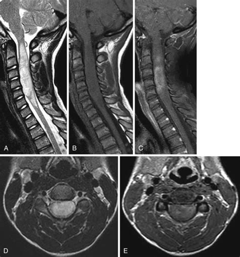 Spinal Tumors | Radiology Key