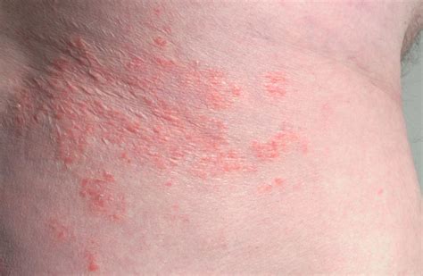 Inverse psoriasis vs. intertrigo: Symptoms, causes, and identification