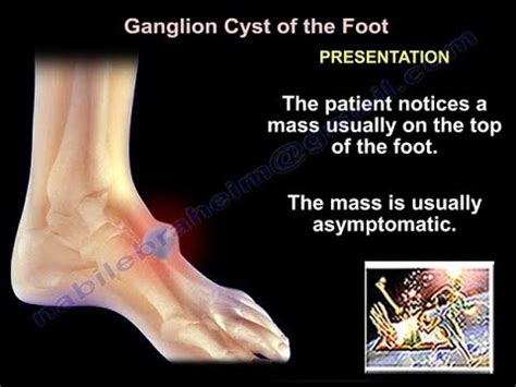 Ganglion Cyst On A Foot Knitting Pattern