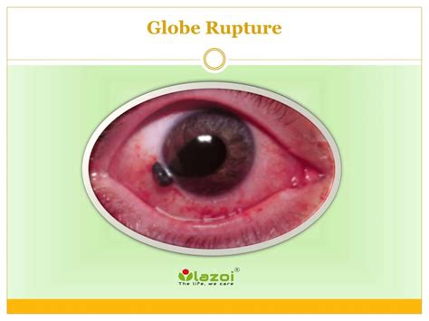 PPT - Globe Rupture PowerPoint Presentation, free download - ID:7955512