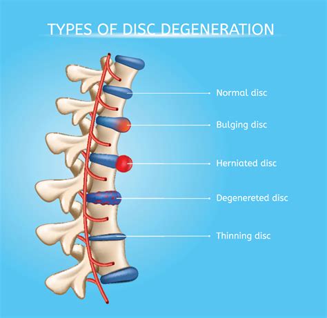 What Does A Disc Problem Feel Like at Reva Blake blog