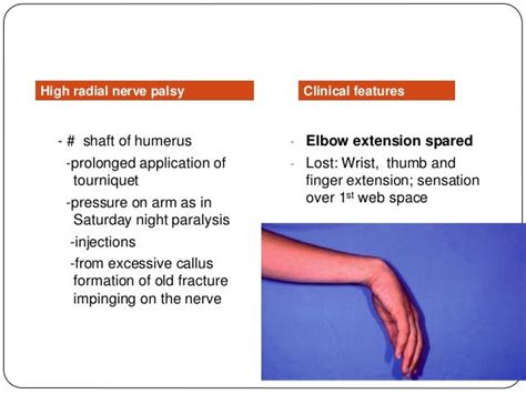 Radial Nerve Palsy