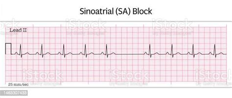 Sinoatrial Block Ecg 8 Second Ecg Paper Stock Illustration - Download ...