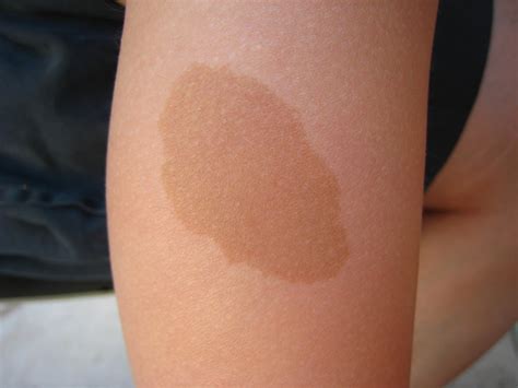 Uneven Skin Tone & Color - Causes & Treatment - How to Get Rid of It