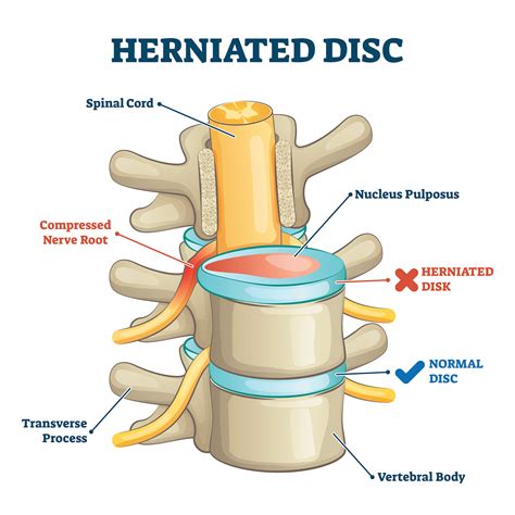 Herniated Disc Treatment - No Drugs or Surgery! | Scottsdale