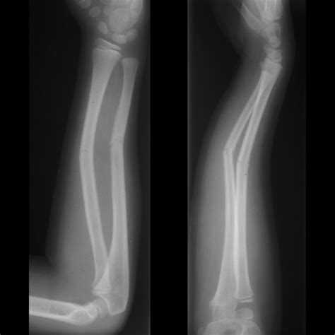 Pediatric Greenstick Fracture | Pediatric Radiology Reference Article ...